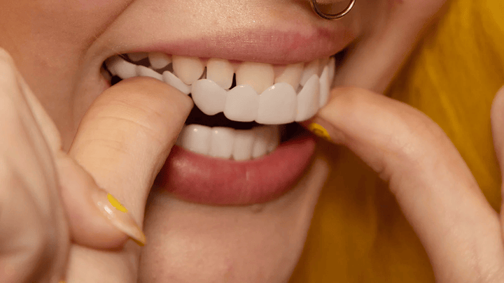 Vrouw glimlacht breed met comfortabele Smile Veneers; cosmetische tanden facings voor direct mooier gebit.