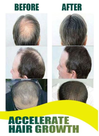Gember Haargroeispray bestrijdt haaruitval en kaalheid effectief. Stimuleert natuurlijke haargroei.