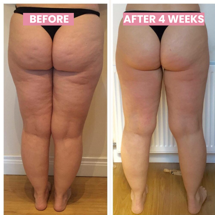 Zichtbaar gladdere huid en vermindering van cellulitis door regelmatige thuisbehandeling met SlimCupp.