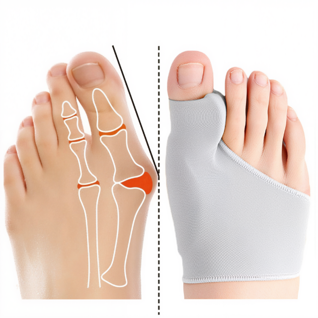 Bunion Corrector Gelpad: teenseparator voor hallux valgus. Orthopedische teenbeschermer tegen voetpijn.