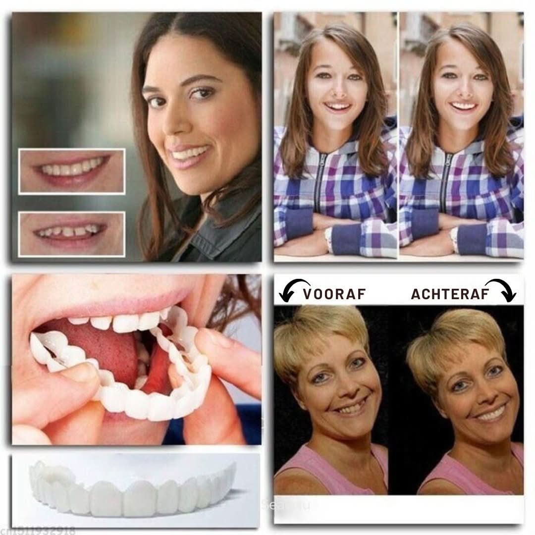 Nieuwe tanden met deze snap-on gebitsprothese. Cosmetisch, comfortabel en verstelbaar voor mondverzorging.